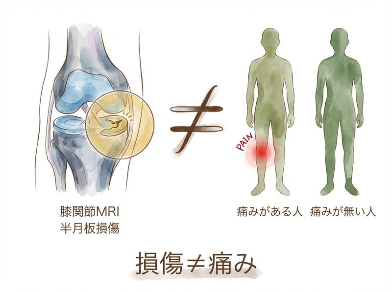半月板損傷と痛みの関係:損傷があっても痛みがない人が多い