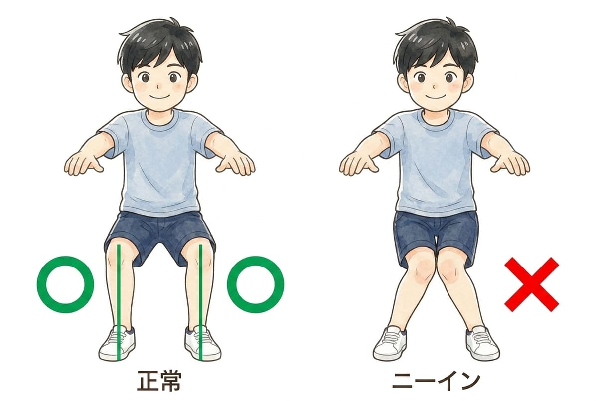 ニーイン(膝の内側への倒れ込み):オスグッドのリスクを高める動作パターン