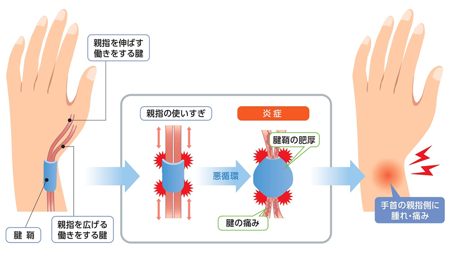 親指の腱鞘炎(ドケルバン病)の症状