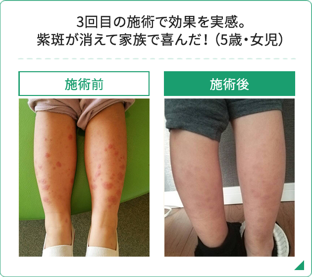 3回目の施術で効果を実感。紫斑が消えて家族で喜んだ! (5歳・女児)