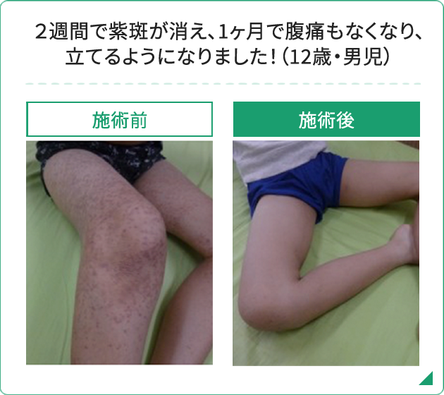 2週間で紫斑が消え、1ヶ月で腹痛もなくなり、立てるようになりました!(12歳・男児)